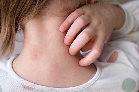 Forstå de forskjellige stadiene av skabb